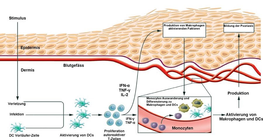 Die Rolle Der Makrophagen Bei Psoriasis 08 2007 Universitat Ulm