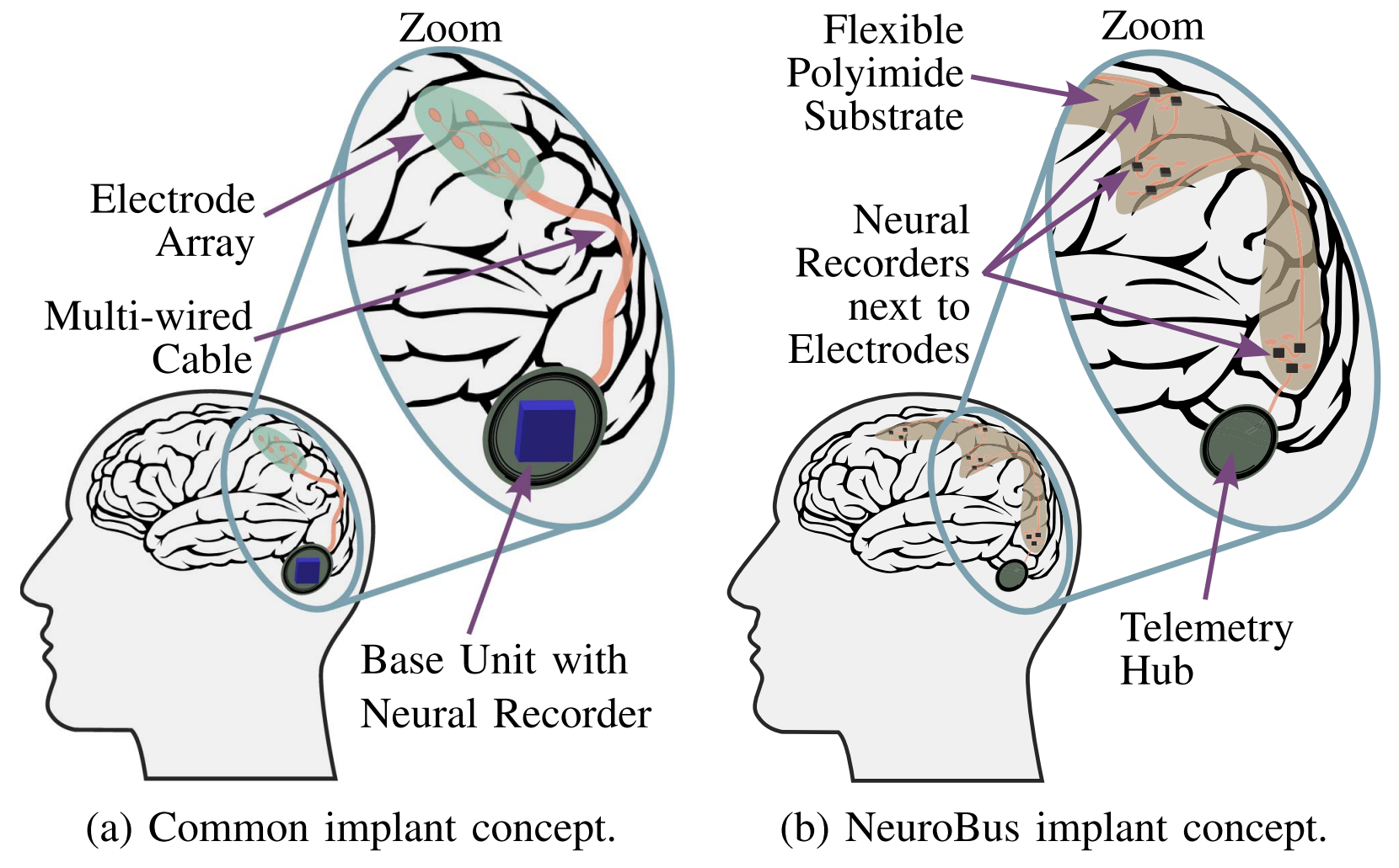 NeuroBus-Implantatkonzept